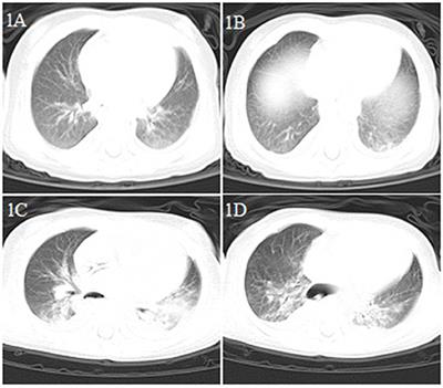 Clinical Characteristics of 5 COVID-19 Cases With Non-respiratory Symptoms as the First Manifestation in Children